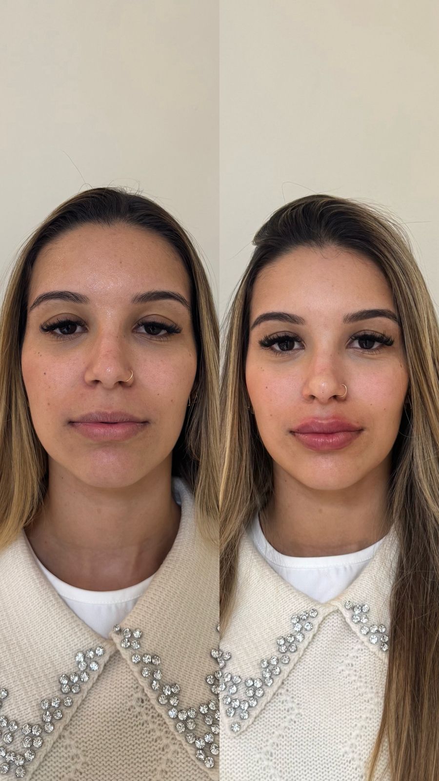Antes e depois de harmonização facial, vista frontal