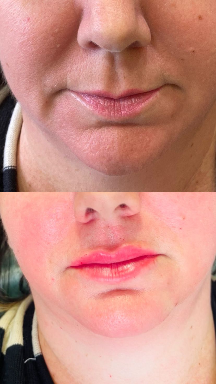 Antes e depois de preenchimento labial