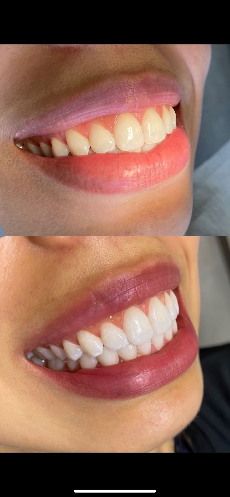 Sorriso antes e depois de tratamento estético dental