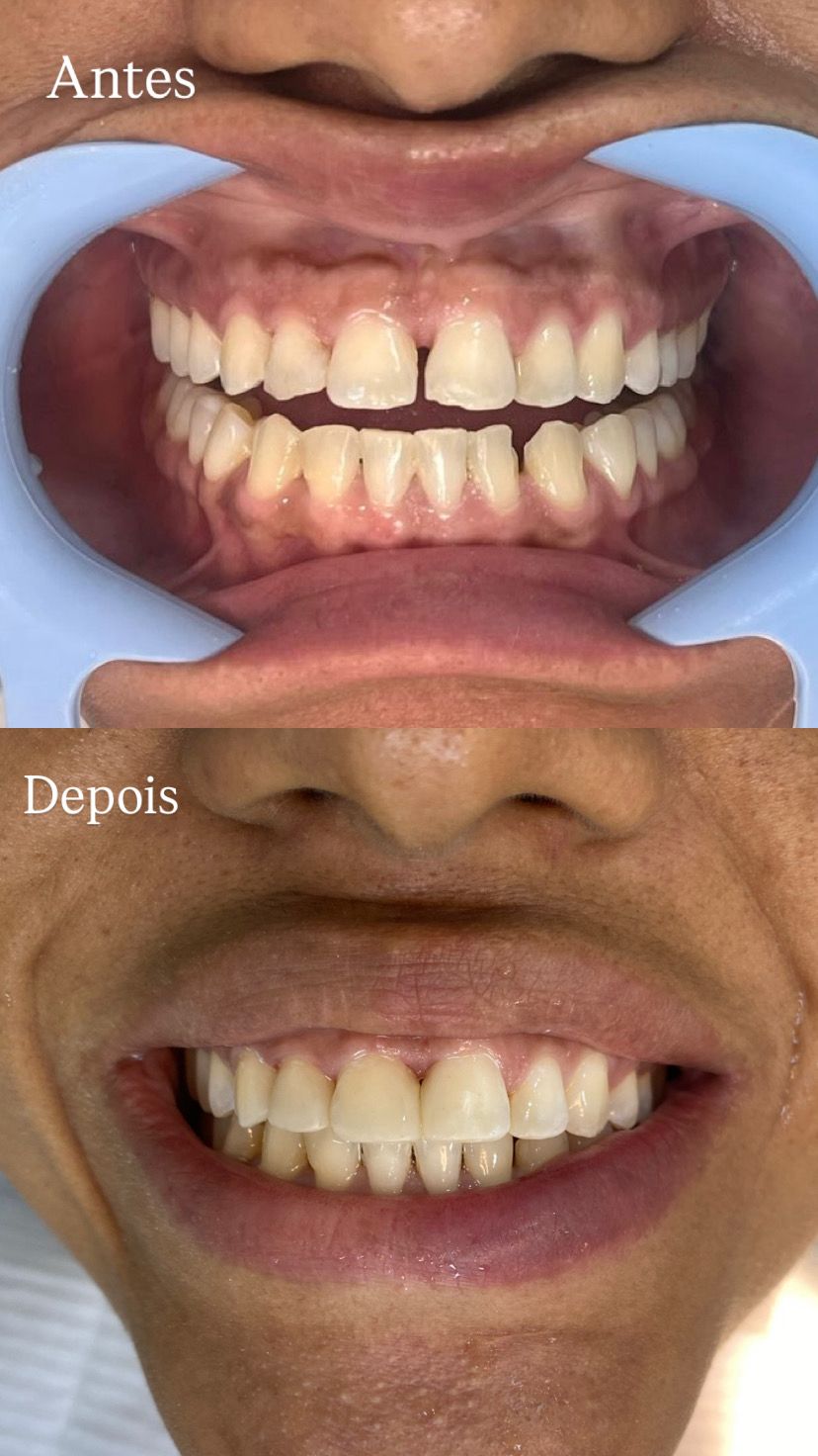Antes e depois de tratamento restaurador em resina