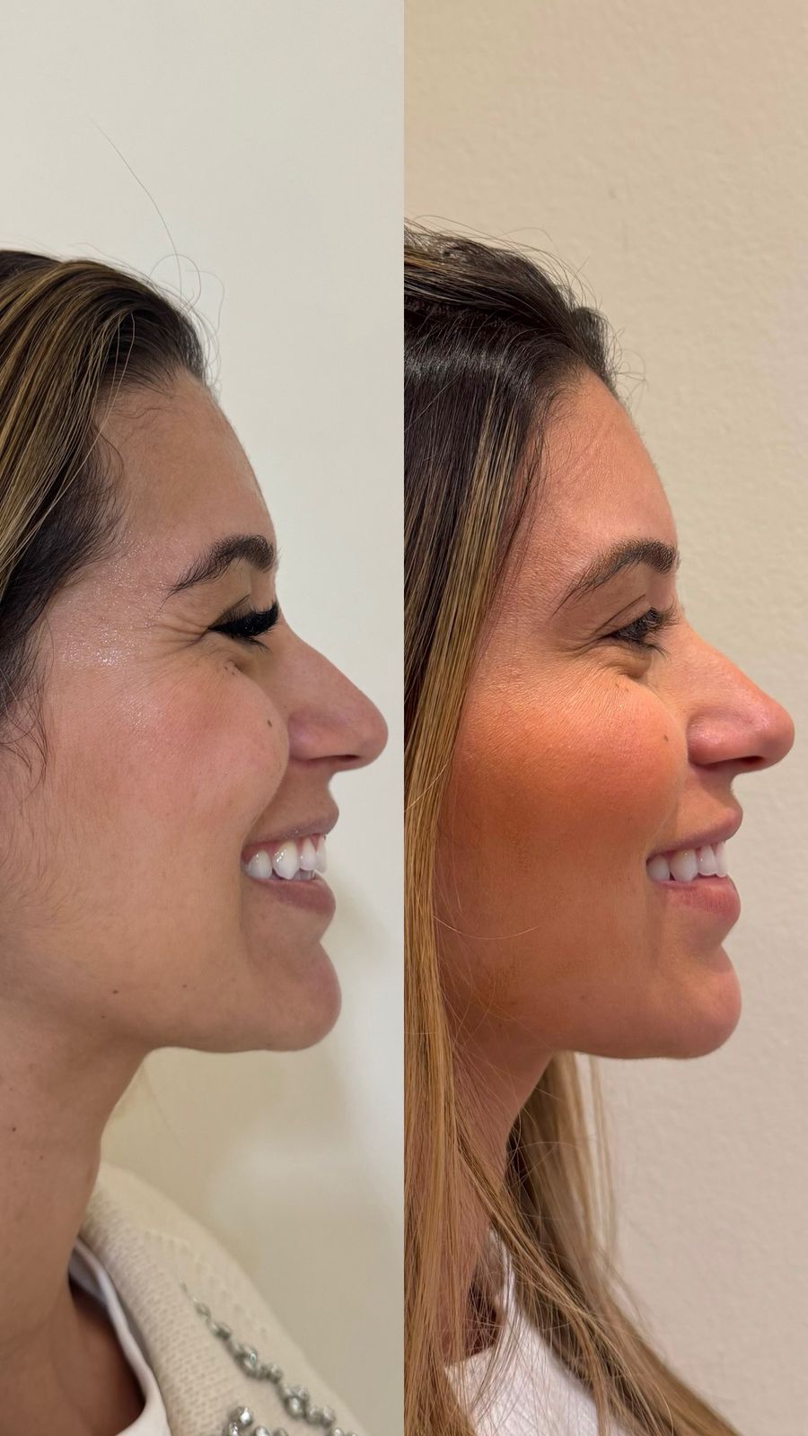 Antes e depois de harmonização facial, perfil sorrindo