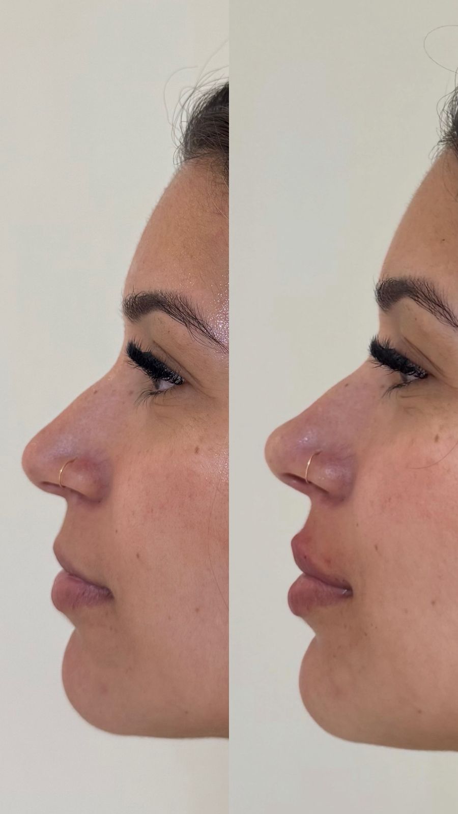 Antes e depois de preenchimento labial, vista de perfil